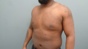 Gynecomastia Before & After Pictures in Nashville, TN