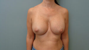 Breast Augmentation Before and After Pictures Nashville, TN