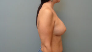 Breast Augmentation Before and After Pictures Nashville, TN