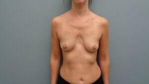 Breast Augmentation Before and After Pictures Nashville, TN