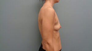 Breast Augmentation Before and After Pictures Nashville, TN