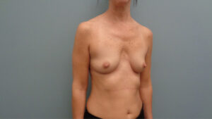 Breast Augmentation Before and After Pictures Nashville, TN