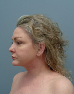 Facelift Before and After Pictures Nashville, TN