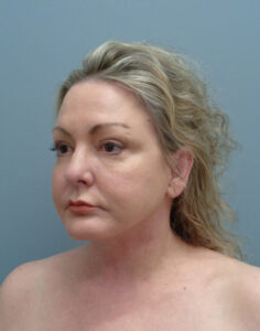 Facelift Before and After Pictures Nashville, TN