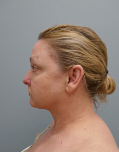 Facelift Before and After Pictures Nashville, TN