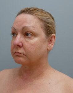 Facelift Before and After Pictures Nashville, TN