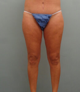 Thigh Lift Before & After Pictures Nashville, Franklin, TN