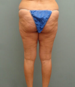 Thigh Lift Before and After Pictures Nashville, TN