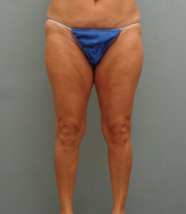 Thigh Lift Before and After Pictures Nashville, TN