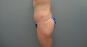 BUTT AUGMENTATION BEFORE AND AFTER PICTURES IN NASHVILLE, TN