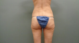 BUTT AUGMENTATION BEFORE AND AFTER PICTURES IN NASHVILLE, TN