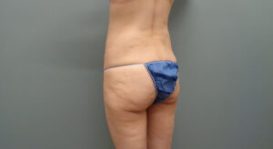 BUTT AUGMENTATION BEFORE AND AFTER PICTURES IN NASHVILLE, TN