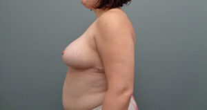 Breast Reduction Before & After Pictures Nashville, TN