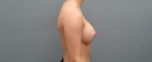 Breast Augmentation Before and After Pictures Nashville, TN