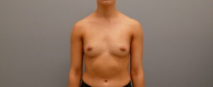 Breast Augmentation Before and After Pictures Nashville, TN