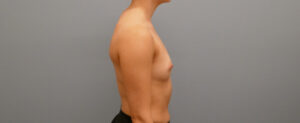 Breast Augmentation Before and After Pictures Nashville, TN