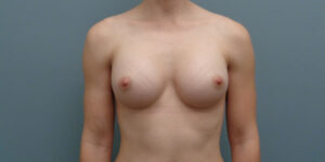 Breast Augmentation Before and After Pictures Nashville, TN