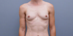 Breast Augmentation Before and After Pictures Nashville, TN