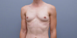 Breast Augmentation Before and After Pictures Nashville, TN