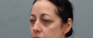 Blepharoplasty Before and After Pictures Nashville, TN