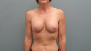 Breast Augmentation with Lift Before and After Pictures Nashville, TN