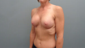 Breast Augmentation with Lift Before and After Pictures Nashville, TN