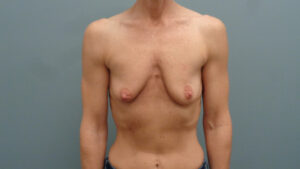 Breast Augmentation with Lift Before and After Pictures Nashville, TN