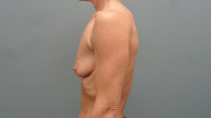 Breast Augmentation with Lift Before and After Pictures Nashville, TN