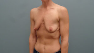 Breast Augmentation with Lift Before and After Pictures Nashville, TN