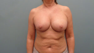 Breast Augmentation with Lift Before and After Pictures Nashville, TN