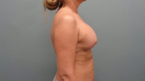 Breast Augmentation with Lift Before and After Pictures Nashville, TN