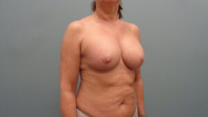 Breast Augmentation with Lift Before and After Pictures Nashville, TN