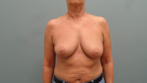 Breast Augmentation with Lift Before and After Pictures Nashville, TN