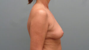 Breast Augmentation with Lift Before and After Pictures Nashville, TN