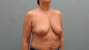 Breast Augmentation with Lift Before and After Pictures Nashville, TN