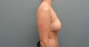 Implant Exchange/Removal Before & After Pictures In Nashville, TN