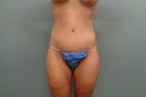 Body Lift Before & After Pictures Nashville, TN