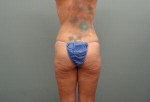 Butt Augmentation Before And After Pictures In Nashville, TN