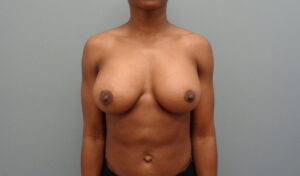 Breast Augmentation Before and After Pictures Nashville, TN