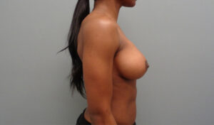 Breast Augmentation Before and After Pictures Nashville, TN