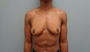 Breast Augmentation Before and After Pictures Nashville, TN