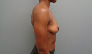 Breast Augmentation Before and After Pictures Nashville, TN