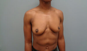 Breast Augmentation Before and After Pictures Nashville, TN