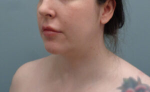 Chin Augmentation Before & After Pictures Nashville, TN