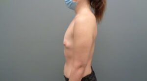 Breast Augmentation Before & After Pictures in Nashville, TN