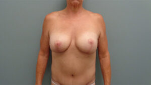 Breast Augmentation with Lift Before and After Pictures in Nashville, TN