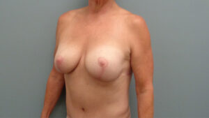 Breast Augmentation with Lift Before and After Pictures Nashville, TN