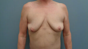 Breast Augmentation with Lift Before and After Pictures in Nashville, TN