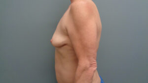 Breast Augmentation with Lift Before and After Pictures in Nashville, TN