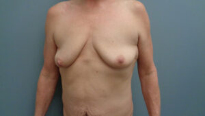 Breast Augmentation with Lift Before and After Pictures in Nashville, TN